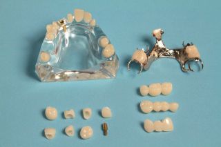 Dental Demonstration Model (A) ; Implant, Implants, Bridge, Partial