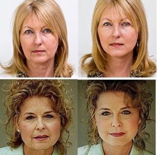 Instant Facelift Necklift Tapes Kit Now from UK
