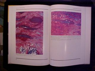 Stary Atlas of Atherosclerosis Progression Regression 1850704805