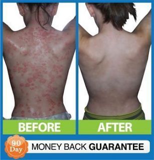 Better than e45   Guaranteed, Fast relief from eczema INT50